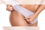 how to treat red stretch marks, difference between red and white stretch marks, difference between red and white stretch marks explained and it s natural to have them, Stretch marks